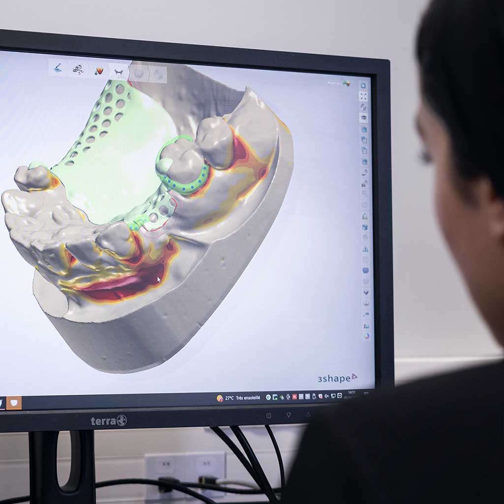 Conception numérique de prothèses dentaires CAO